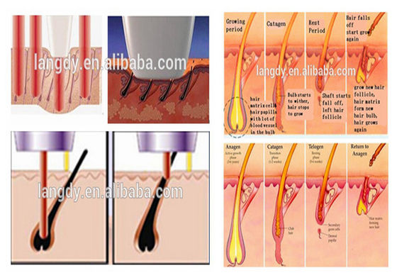 2000w 950nm Permanent IPL Hair Removal Machine