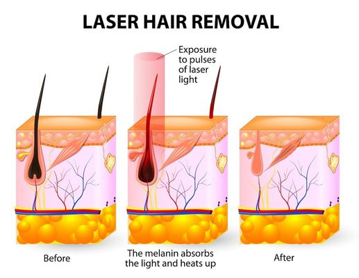Spa Salon 20HZ 808 Diode Laser Hair Removal Machine