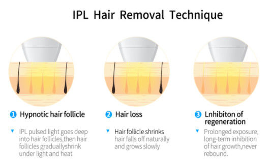 2000w OPT IPL+ 808NM DIODE LASER Technology For Hair Removal Equipment