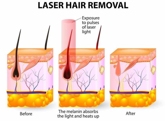 OPT IPL / OPT Multifunctional Machine Portable IPL Fast Hair Removal