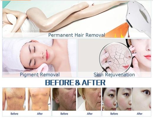 OPT IPL / OPT Multifunctional Machine Portable IPL Fast Hair Removal